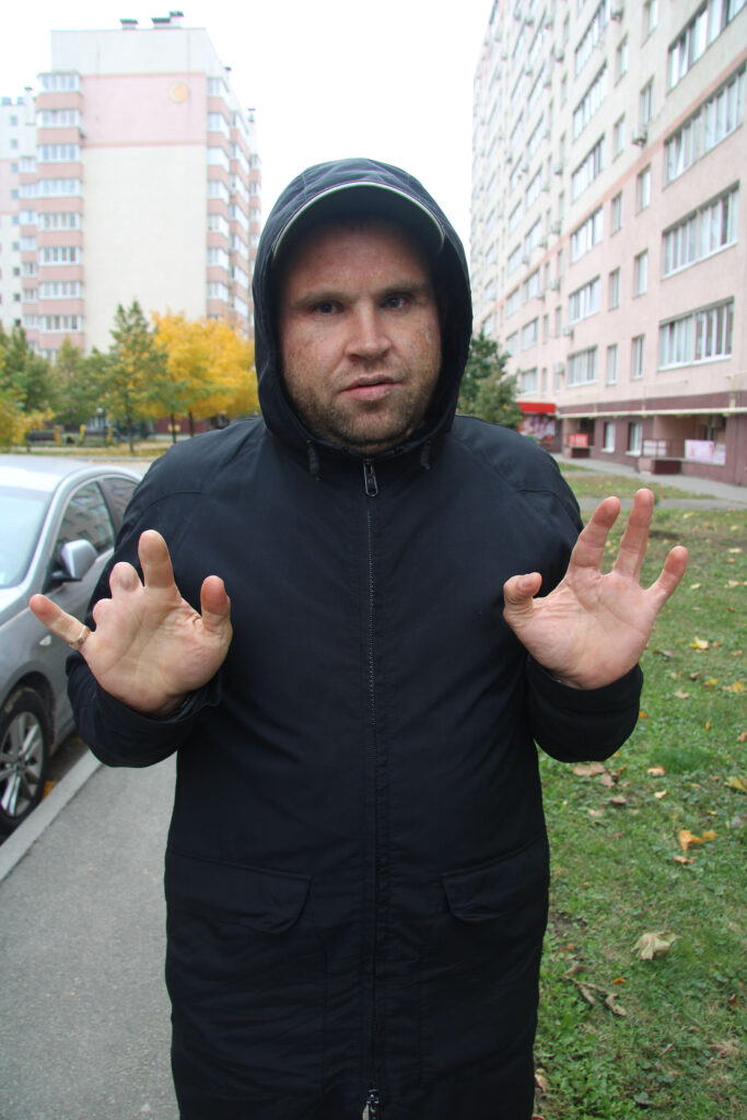 Yuriy Pastushenko mellom boligblokker holder frem hendene som mangler flere fingre